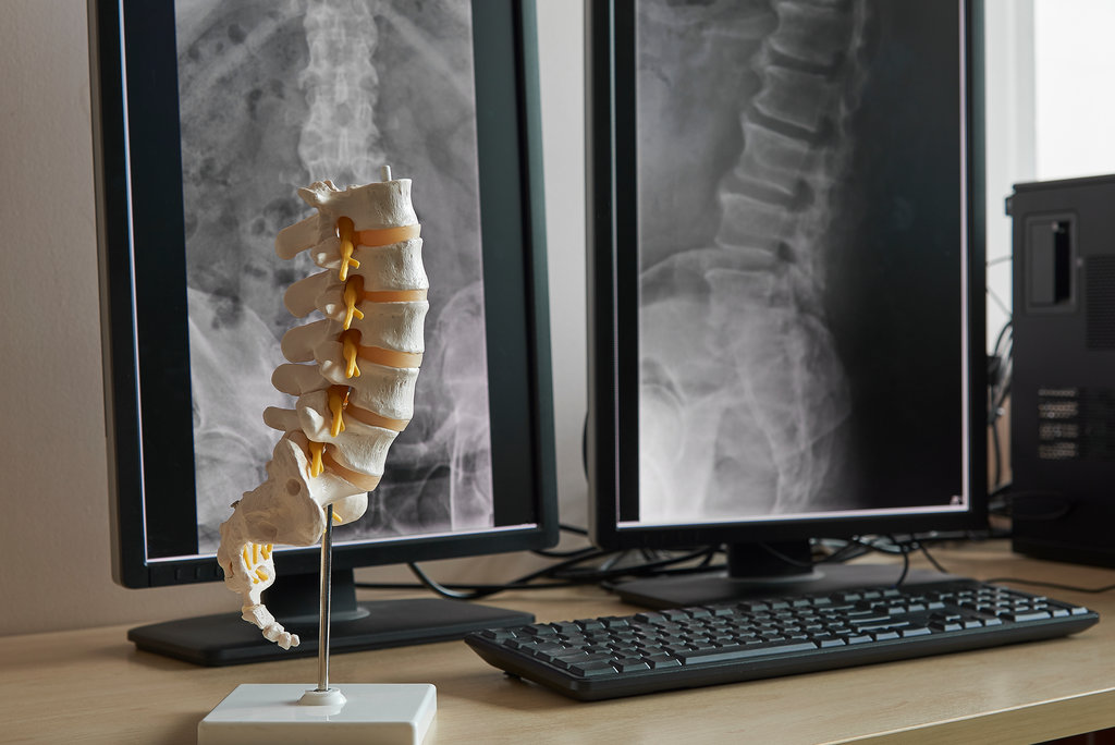 Artificial human lumbar spine model on the table with display monitor of lumbar spine x-rays